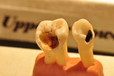 Черный налет на зубах: как удалить – стоматология Президент