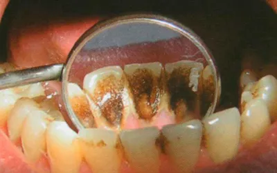 Чернеют зубы - что делать, если зубная эмаль темнеет?