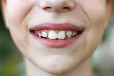 Лечение кариеса молочных зубов у детей, цена в Москве