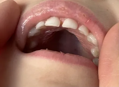 Черные полоски на зубах у ребенка: причины и способы лечения