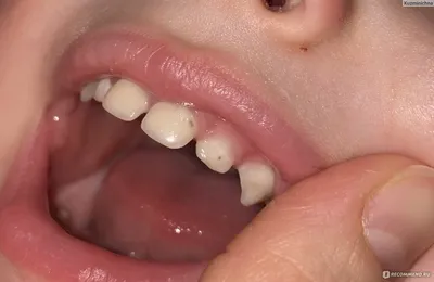 Зубы у детей - Stomatologia Zili Clinic