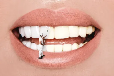 Советы по лечению почерневших зубов
