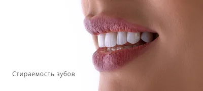 Флюороз зубов: причины, клинические симптомы, диагностика и лечение у  стоматолога, профилактика пятен на эмали