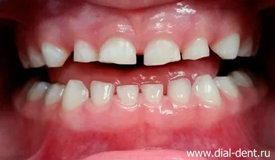 Кариес между зубами лечение, виды межзубного кариеса, цены.