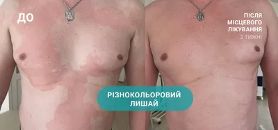 Опоясывающий лишай Versicolor или Pityriasis альбы в шею юго-восточной азии  человека Стоковое Фото - изображение насчитывающей заболевание, наведено:  196972444