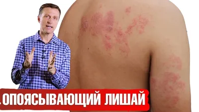 Герпес: симптомы и лечение, рекомендации врача | Семейный доктор