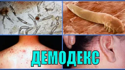 О мерах профилактики чесотки