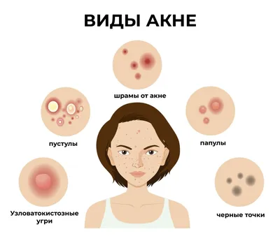 Акне – лечение в медцентре «Номосклиник» | Стоимость процедуры в Москве,  отзывы, вопросы и ответы