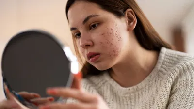 Акне и постакне: путь к здоровой и красивой коже | косметология в Северном  Бутово