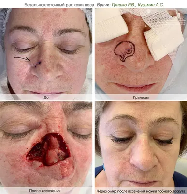 Базалиома кожи: фото, как выглядит, лечение и прогноз выживаемости при раке  кожи