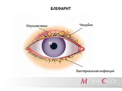 Блефарит: симптомы и лечение. Виды блефарита