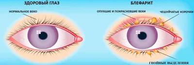 Офтальмологический центр доктора Курбанова - Блефарит — это патология,  которая поражает веки и вызывает воспаление на их краях, сопровождающееся  раздражением и покраснением глаз. Существует несколько видов блефарита:  ✓Передний: поражает внешнюю часть ...