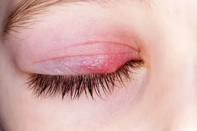 Блефарит: симптомы, причины, лечение этого заболевания глаз. - Всё о зрении.