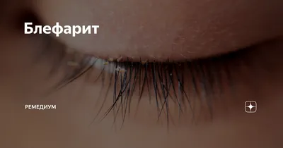 По каким симптомам можно распознать блефарит — распространенное заболевание  глаз - Страсти