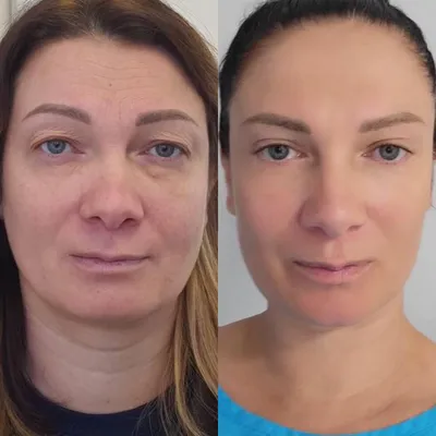 Пластика век - цена, фото до и после операции, отзывы пациентов. Стоимость  блефаропластики в Москве - клиника Beauty Trend