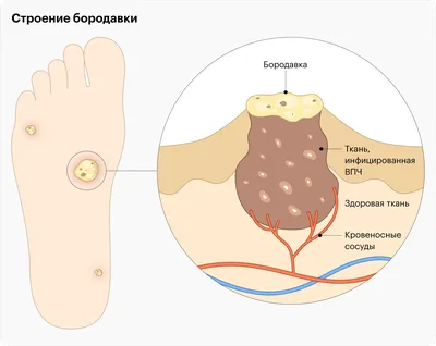 Когда и как надо удалять бородавки | OmniaClinic