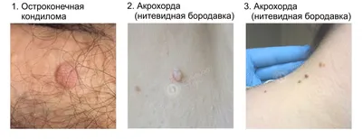 Удаление бородавок в Самаре цены | Клиники доктора Кравченко