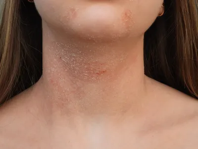 дизидротический экзема - аллергическое состояние кожи. Стоковое Изображение  - изображение насчитывающей здорово, людск: 229825815