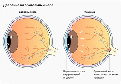 Глаукома: симптомы, причины, лечение болезни лекарствами, операция, виды и  стадии развития