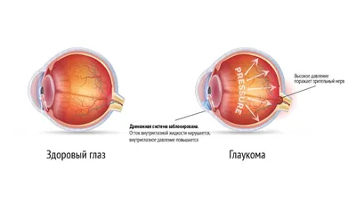 Глаукома . Что мы лечим. МНТК \"Микрохирургия глаза\"