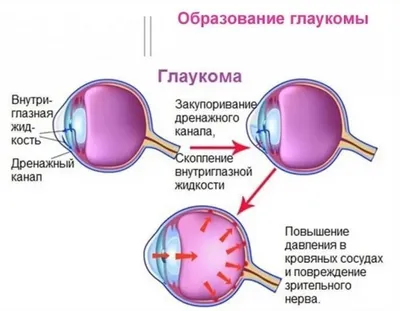 Глаукома глаза: симптомы, причины возникновения, лечение