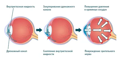 Глаукома – что это, симптомы, причины возникновения, виды, диагностика,  лечение и профилактика