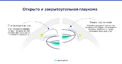 Глаукома - лечение в Москве, симптомы и причины глазной галукомы