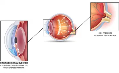 Лечение глаукомы медикаментозно, оперативно, лазером |Zrenie