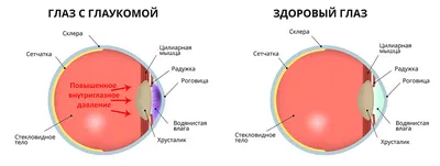 Острая глаукома симптомы