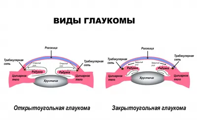 Глаукома и катаракта одновременно – лечение и операция