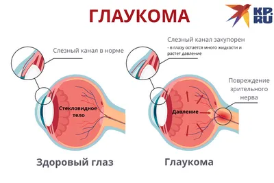 Заболевание глаз - глаукома - online presentation