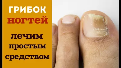 Избавьтесь от грибка ногтей: причины, симптомы и эффективные методы лечения