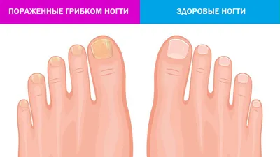 Лечение грибка стопы | Уход от грибка ногтей - Nailyuba