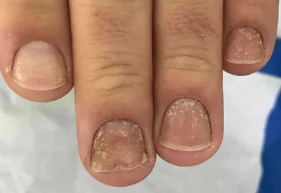 ᐉ Грибок ногтей (онихомикоз): способы лечения быстро в домашних условиях