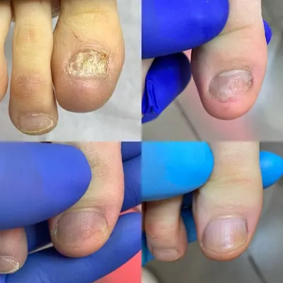Грибок ногтей на ногах - симптомы, первые признаки, причины, как определить  болезнь