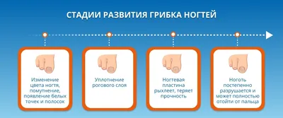 Грибок ногтей на ногах: что это, причины, сколько стоит лечение, лекарства  от онихомикоза