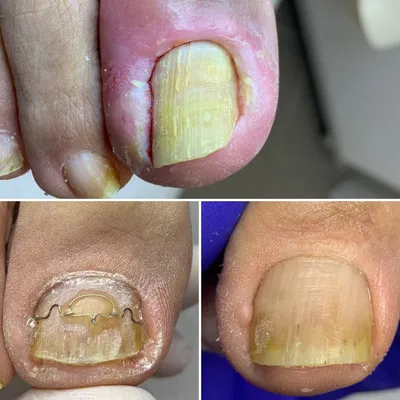 CURED nail fungus after 30 years - YouTube