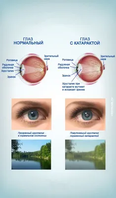 Катаракта - стадии развития и методы лечения - Офтальмологические клиники  «Эксимер» (Одесса) - диагностика и лечение заболеваний глаз у взрослых и  детей