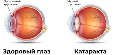 Катаракта - причины, симптомы, лечение и диагностика