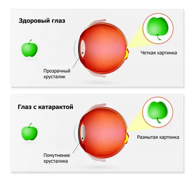 Лазерное лечение катаракты и вторичной катаракты глаза в Волгограде от  10000 руб