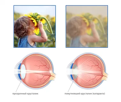Просто о сложном: что такое катаракта, как лечить катаракту? | Микрохирургия