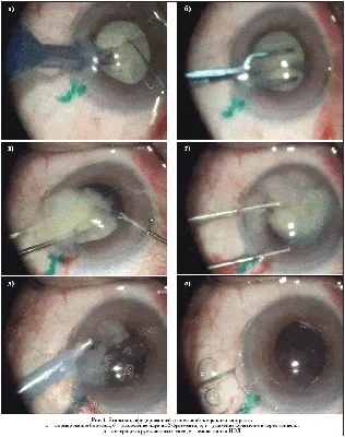 Лечение катаракты – Центр микрохирургии глаза