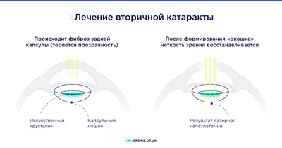 Что такое катаракта? | Théa