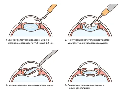 Первые признаки и причины катаракты - ОФТАЛЬМОЛОГИЯ | Добро пожаловать в  «Клинику Айгерим»