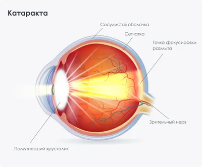 Ядерна катаракта — що це, причини, симптоми та лікування | Блог | GlazGo