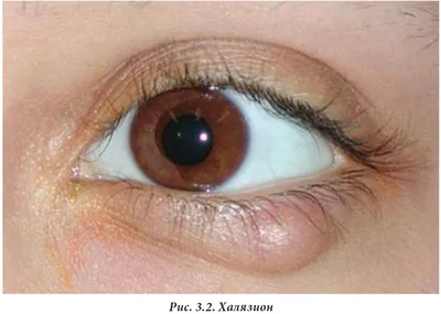 Отзыв о Операция по удалению халязиона на веке глаза | Неприятно. Не  удобно. Не больно.