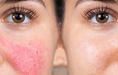Купероз кожи лица: что это такое, причины и симптомы, способы лечения |  Статья | Томск «Доктор Борменталь»