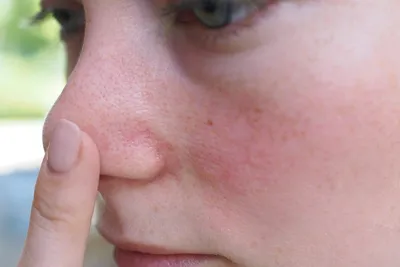 Купероз на лице: причины и лечение, как бороться и избавиться от купероза