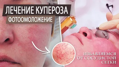 Купероз: как убрать сосуды на лице | 7я.ру | Дзен