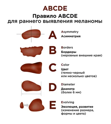 Меланома кожи с поражением центральной нервной системы